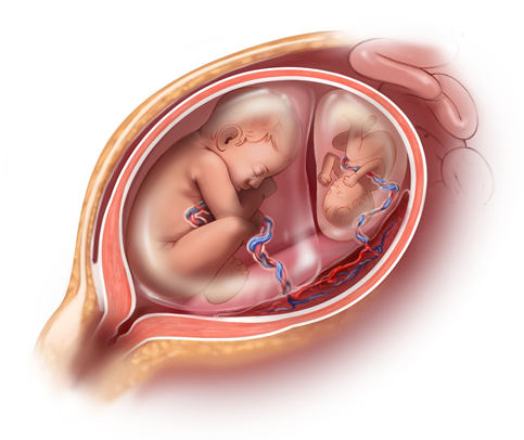 Mẹ bầu mang thai đôi có nguy cơ bị dị tật thai hoặc thai phát triển bất thường cao hơn thai đơn
