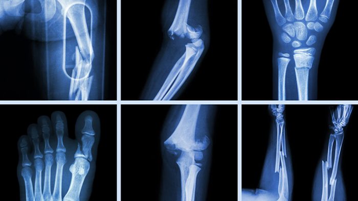 Dân văn phòng nên đi chụp x-quang cổ tay để phòng tránh nhiều bệnh nguy hiểm 