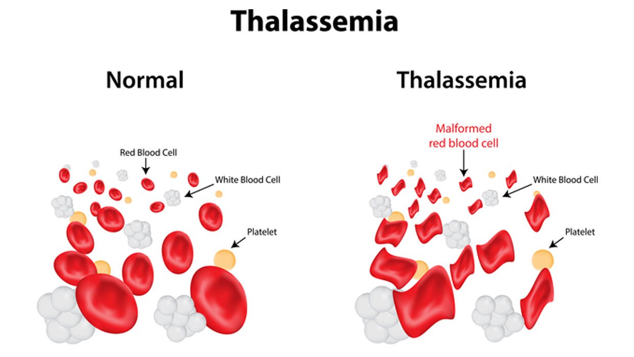 Tế bào máu khi mắc hội chứng Thalassemia