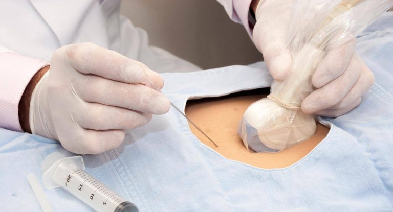 Xét nghiệm sinh thiết nhau thai