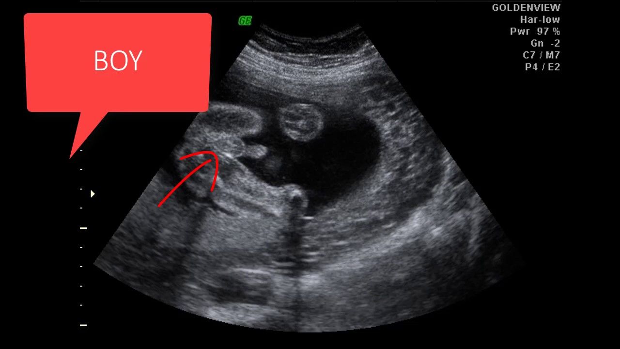 Thông qua siêu âm có thể xác định giới tính thai nhi là trai hay gái khá chính xác